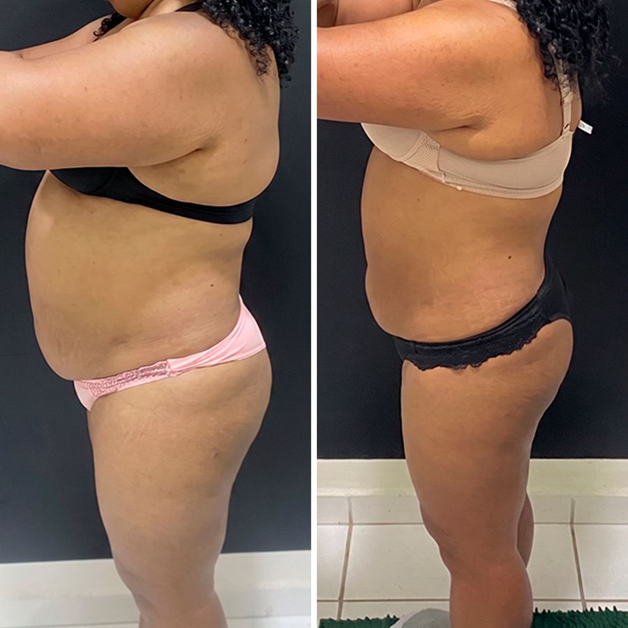 Antes e depois, resultado real de paciente da Clínica YK, vista lateral