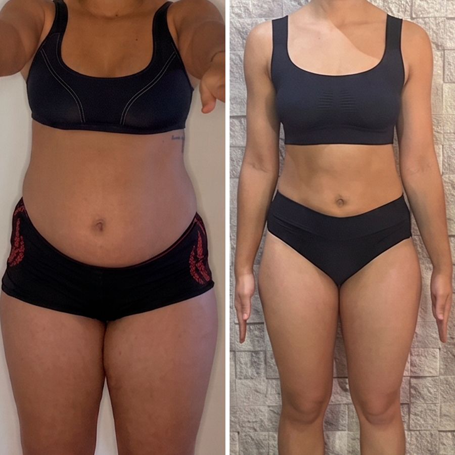 Antes e depois, resultado real de paciente da Clínica YK, vista frontal